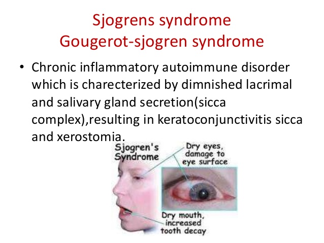 Sjogren's Syndrome and Glutathione