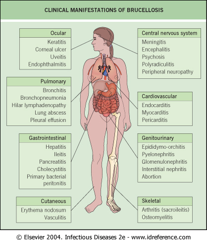 Brucellosis and Glutathione